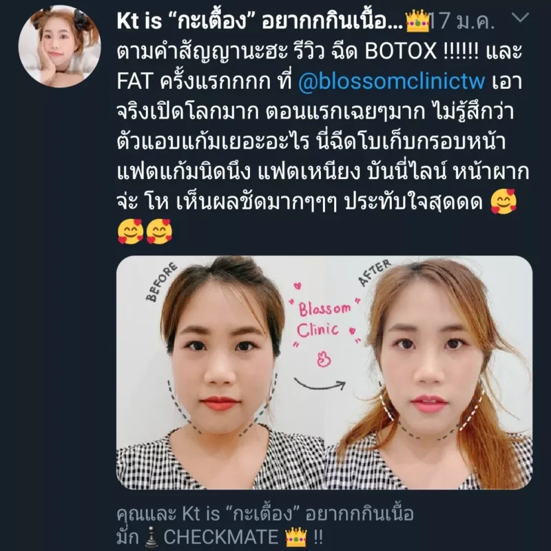 รีวิวจากผู้ใช้บริการ ฉีดโบท็อกลดกราม ลดแก้ม ให้รูปหน้าเรียวขึ้น