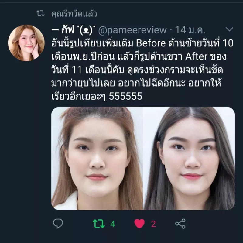 รีวิวจากผู้ใช้บริการ ฉีดโบท็อกลดกราม ให้รูปหน้าเรียวขึ้น