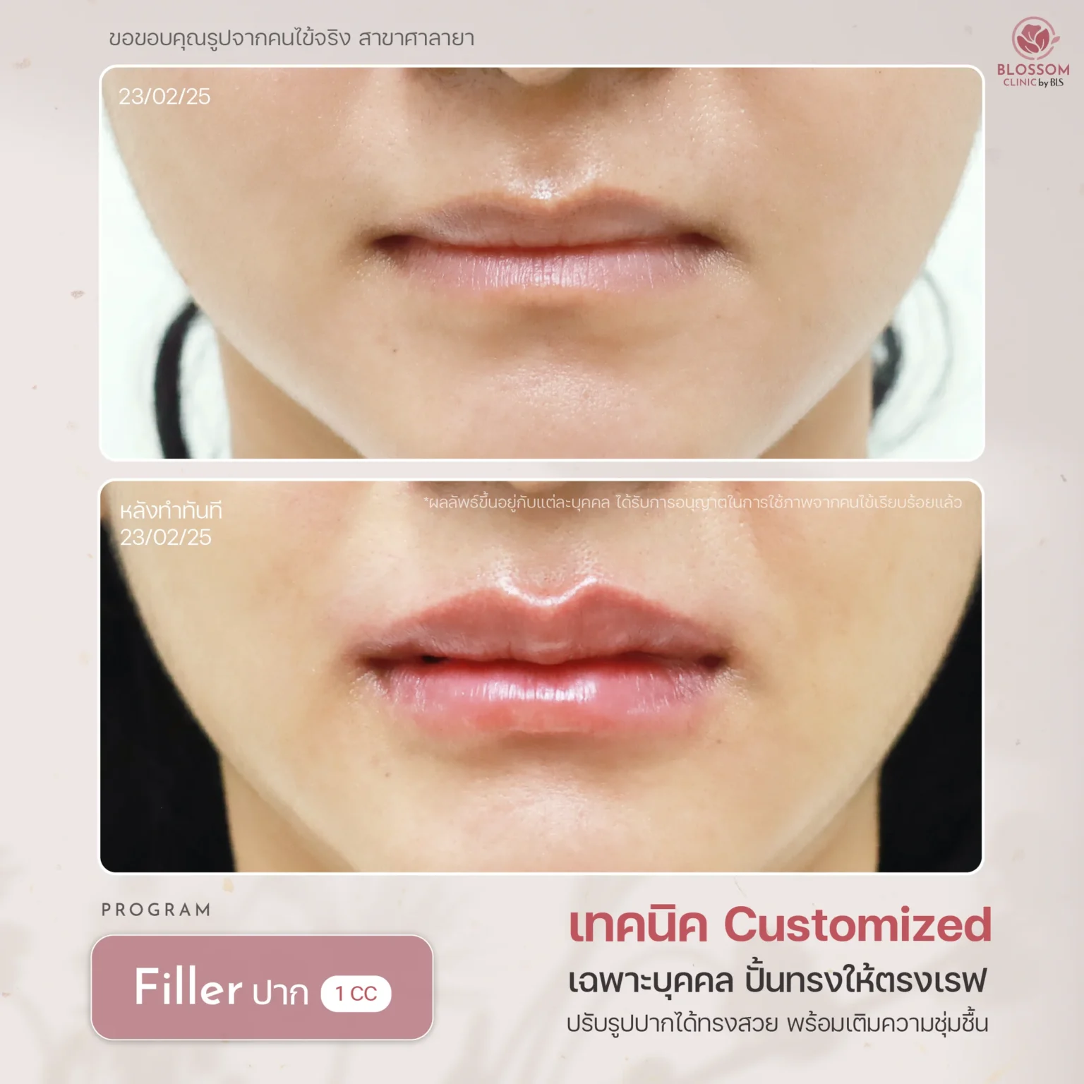 รีวิวผลลัพธ์ฉีด Filler (ฟิลเลอร์)