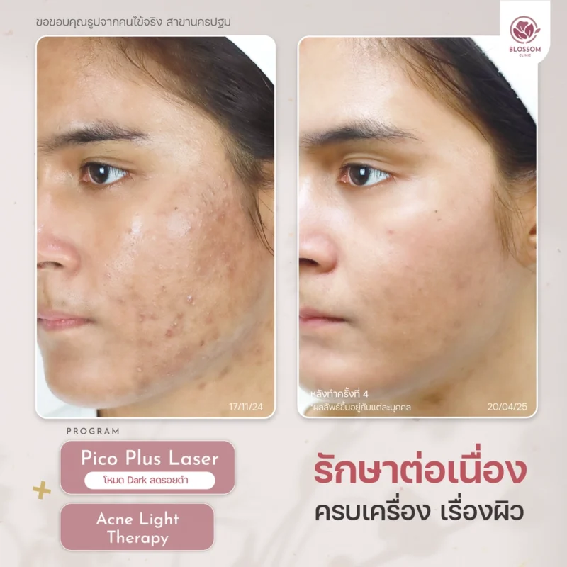 รีวิว Pico Plus Laser ที่ บลอสซั้ม คลินิก