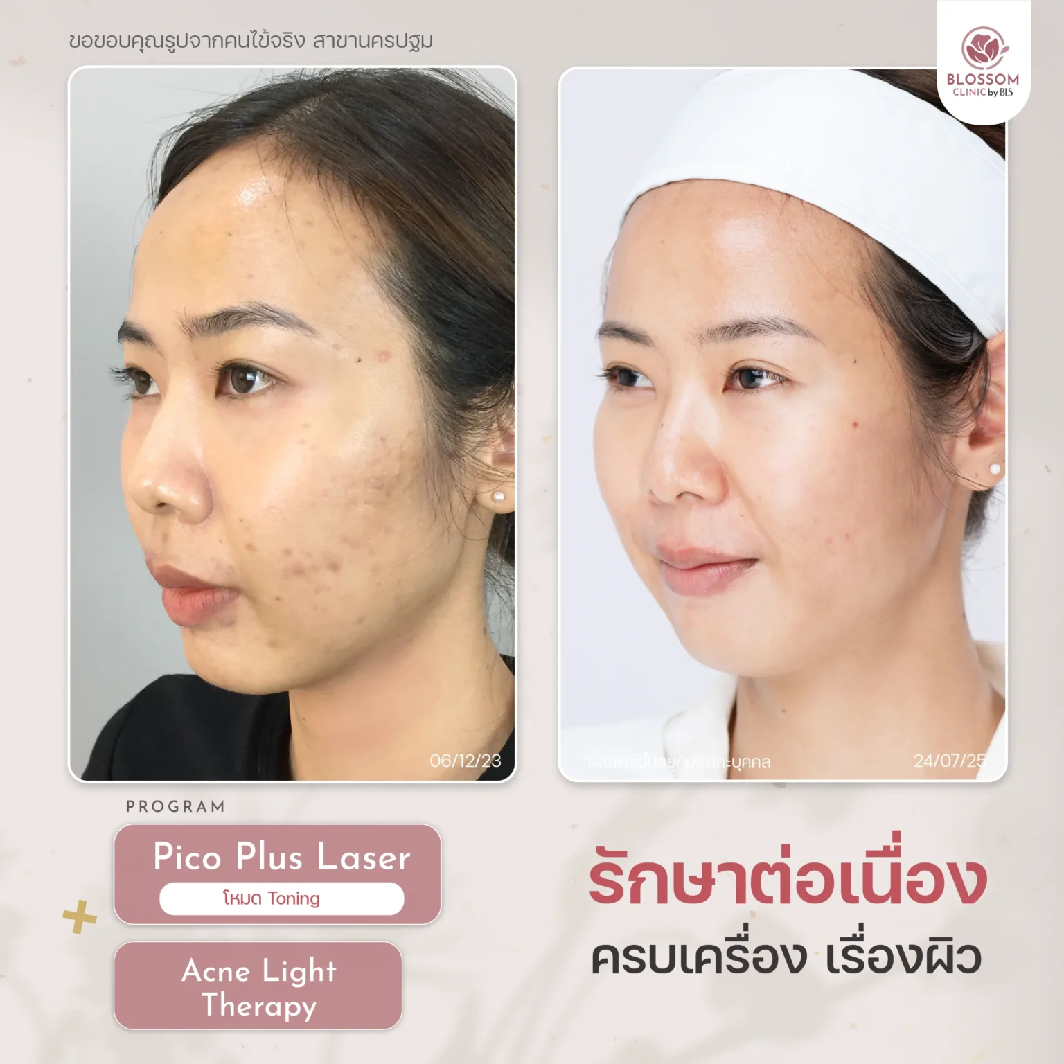 รีวิวผลลัพธ์ Pico Plus Laser