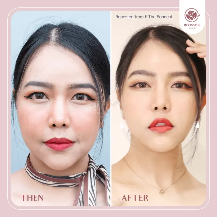 รีวิวก่อนทำ และหลังทำการยกกระชับใบหน้า