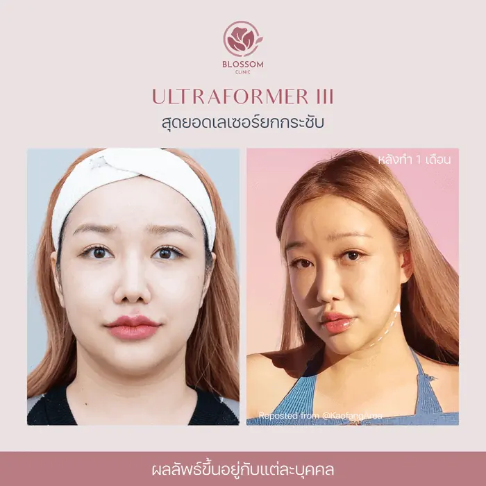 Ultraformer III สุดยอดเลเซอร์ยกกระชับใบหน้า