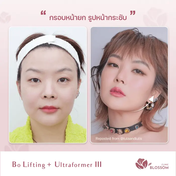 Bo Lifting + Ultraformer III การทำยกกระชับใบหน้า