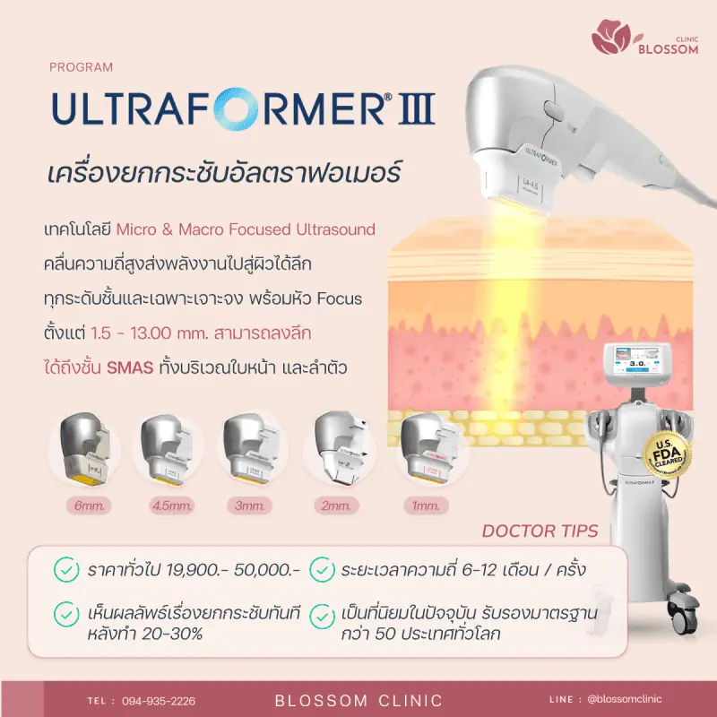 เครื่อง Ultraformer III เป็นเครื่อง ยกกระชับใบหน้า อัลตราฟอเมอร์