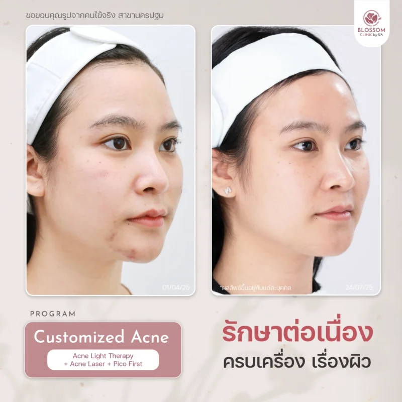 รีวิวผลลัพธ์ โปรแกรมรักษาสิว