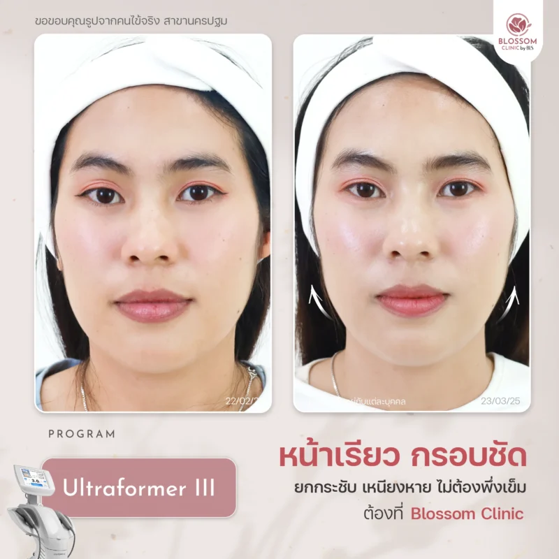 รีวิวผลลัพธ์ Ultraformer III
