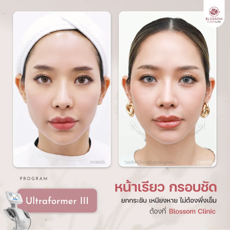 รีวิว Ultraformer III ที่ บลอสซั้ม คลินิก