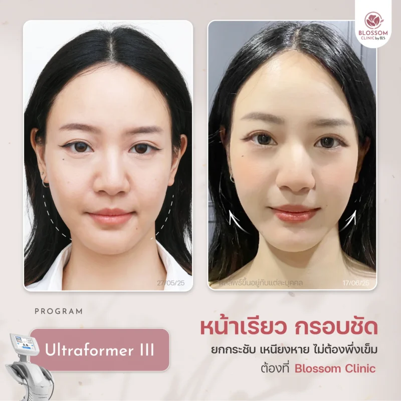 รีวิว Ultraformer III ที่ บลอสซั้ม คลินิก