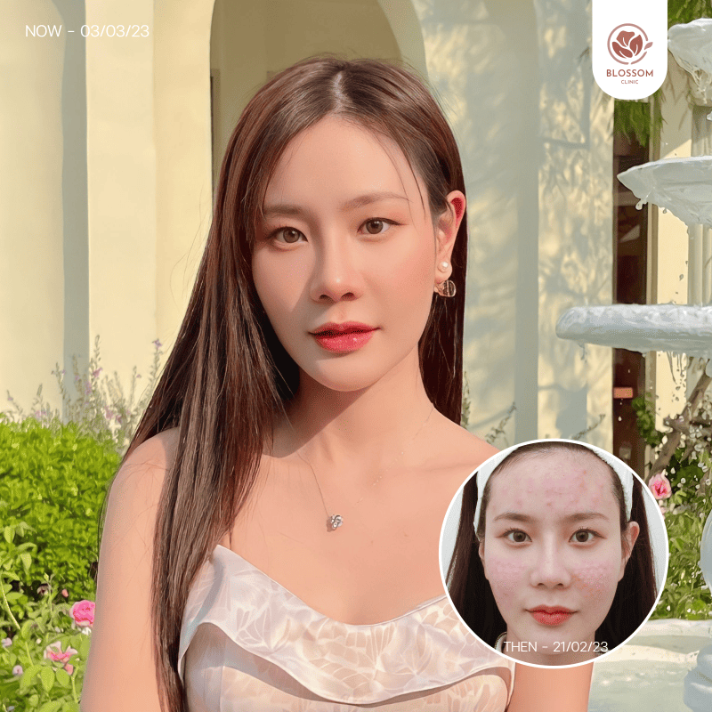 รับบริการโปรแกรม Rejuran ที่ Blossom Clinic