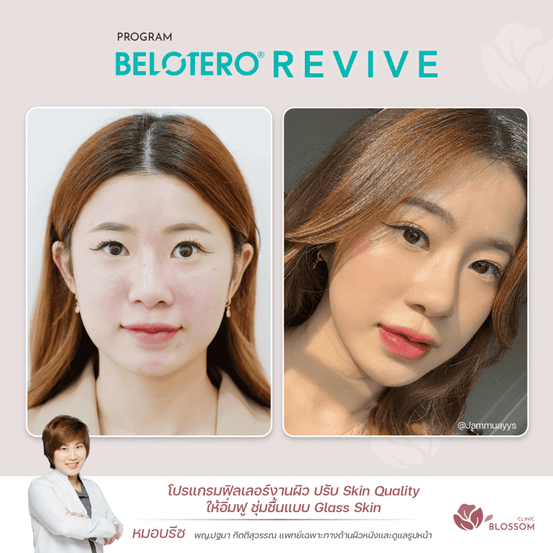 ชมรีวิว Rejuran I Made Collagen I Belotero I Sculptra กู้ผิวหน้า เด้งใสขึ้น สวยๆ จาก Blossom Clinic