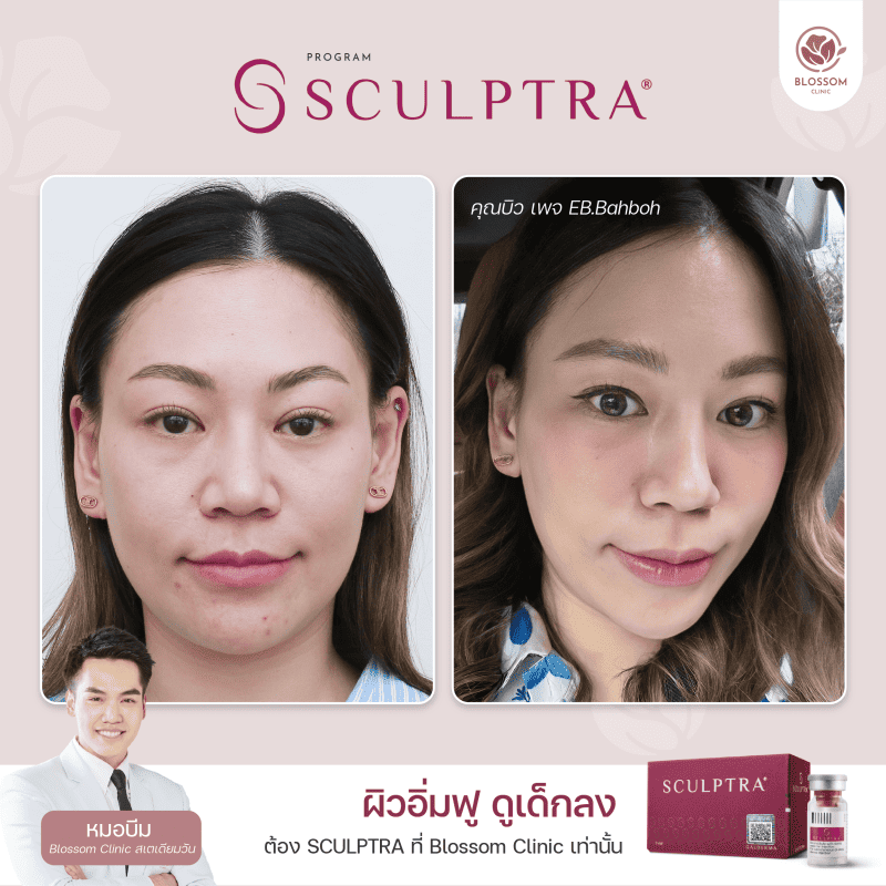 ชมรีวิว Rejuran I Made Collagen I Belotero I Sculptra กู้ผิวหน้า เด้งใสขึ้น สวยๆ จาก Blossom Clinic