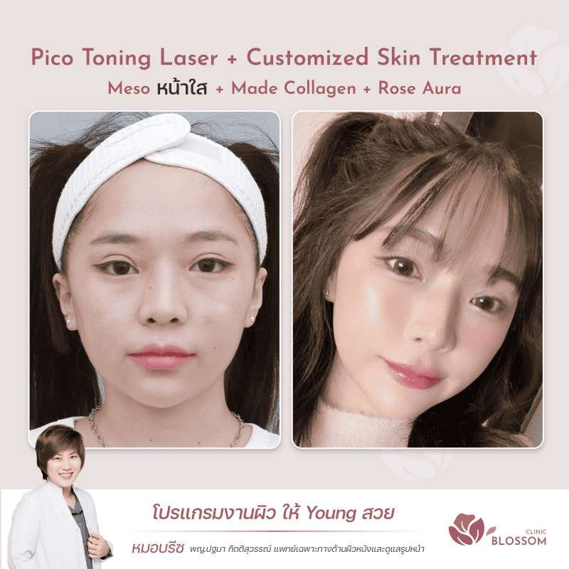 ชมรีวิว Rejuran I Made Collagen I Belotero I Sculptra กู้ผิวหน้า เด้งใสขึ้น สวยๆ จาก Blossom Clinic