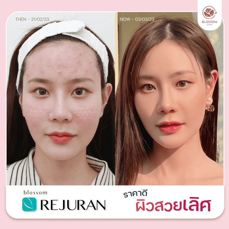 ชมรีวิว Rejuran I Made Collagen I Belotero I Sculptra กู้ผิวหน้า เด้งใสขึ้น สวยๆ จาก Blossom Clinic