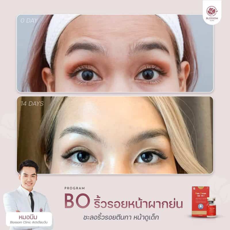 โปรแกรม Botulinum toxin ปรับรูปหน้า ลดริ้วรอย