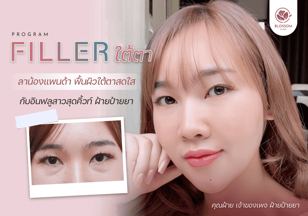 Filler ฟิลเลอร์ ปาก ฟิลเลอร์ใต้ตา ฮิตสุดๆ