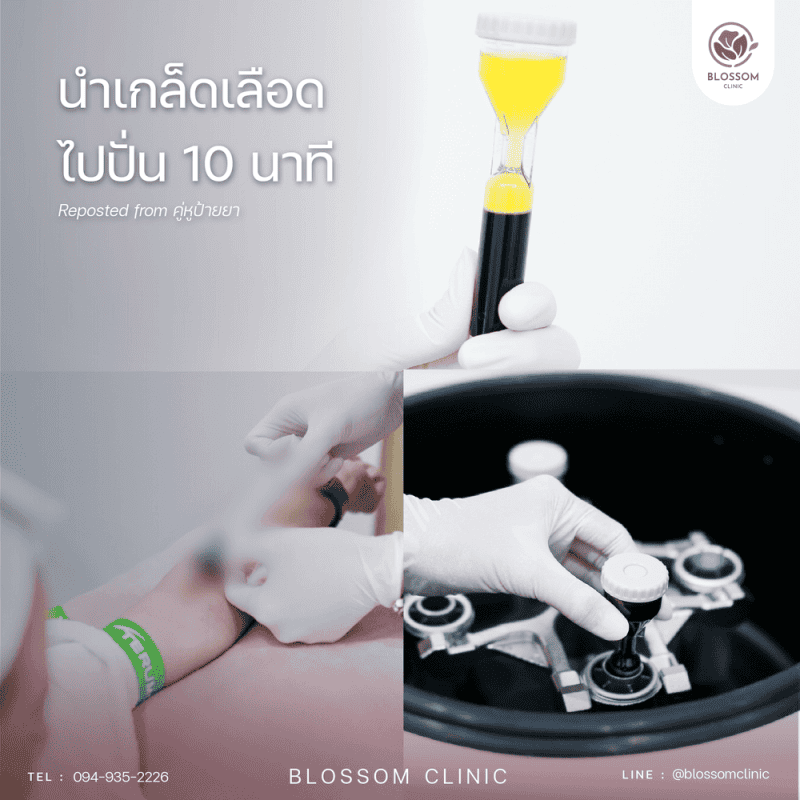 โปรแกรม PRP ที่ดูแลครบจบทั้งผมและผิว | คลินิกเสริมความงามใกล้ฉัน