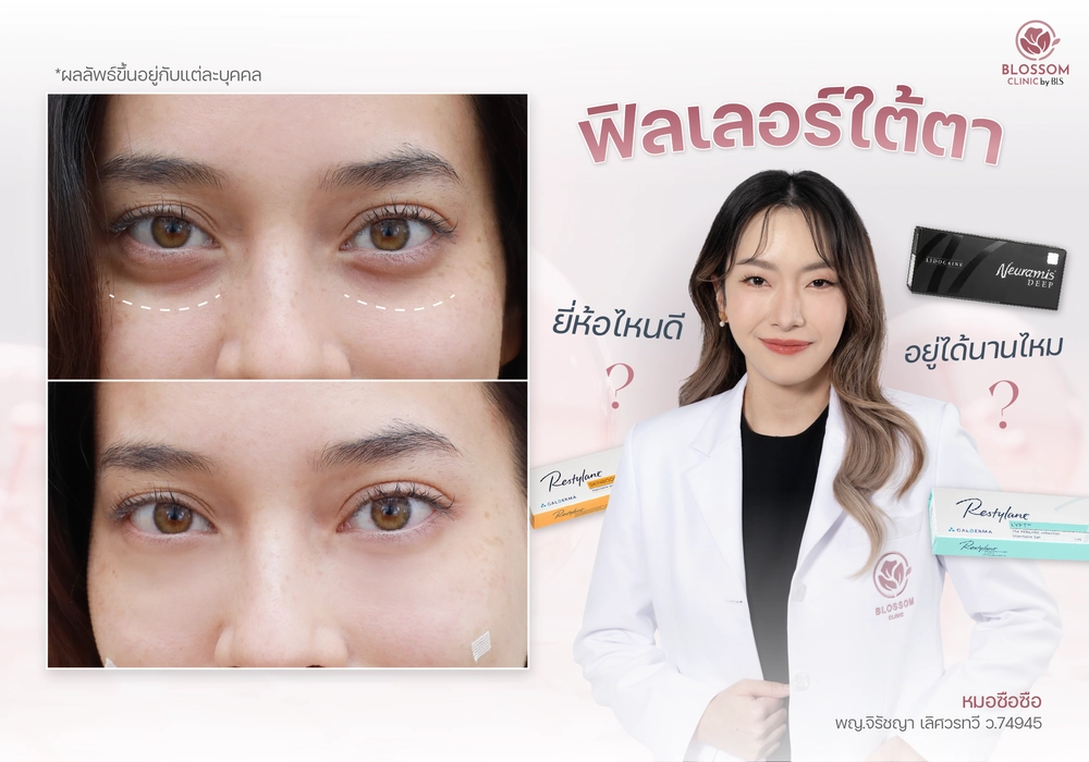 ฟิลเลอร์ใต้ตา อยู่ได้นานไหม? ยี่ห้อไหนดี?