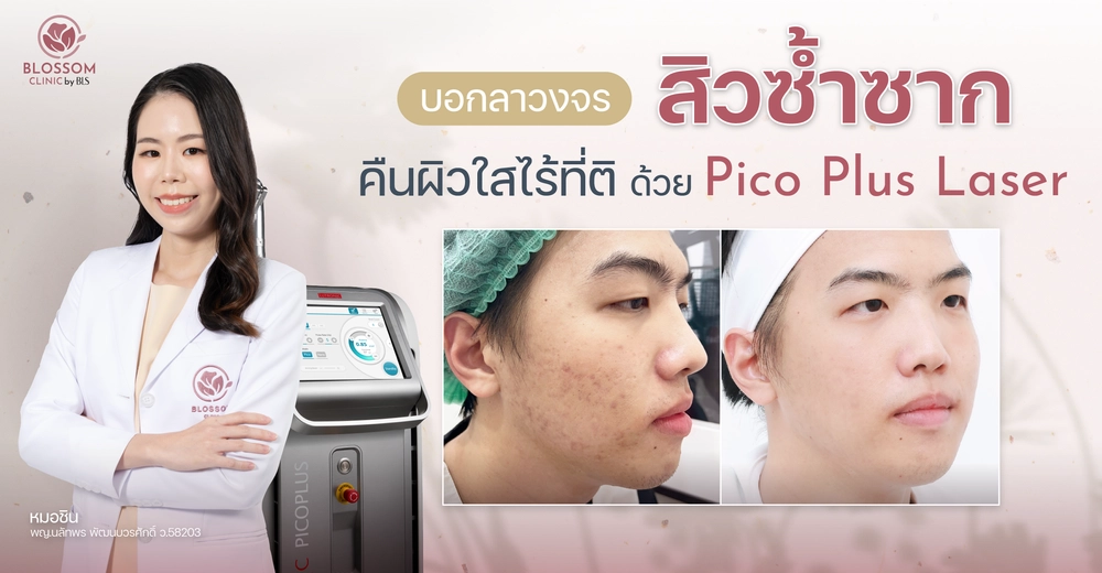 Pico Plus Laser เลเซอร์รอยสิว ลดรอยสิว ลดรอยดำ ลดรอยแดง