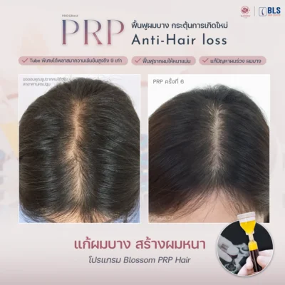 รีวิว PRP Hair ที่ บลอสซั้ม คลินิก