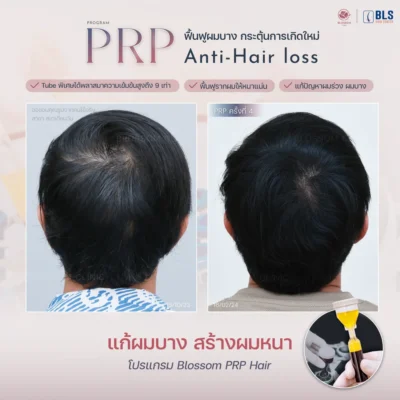 รีวิว PRP Hair ที่ บลอสซั้ม คลินิก