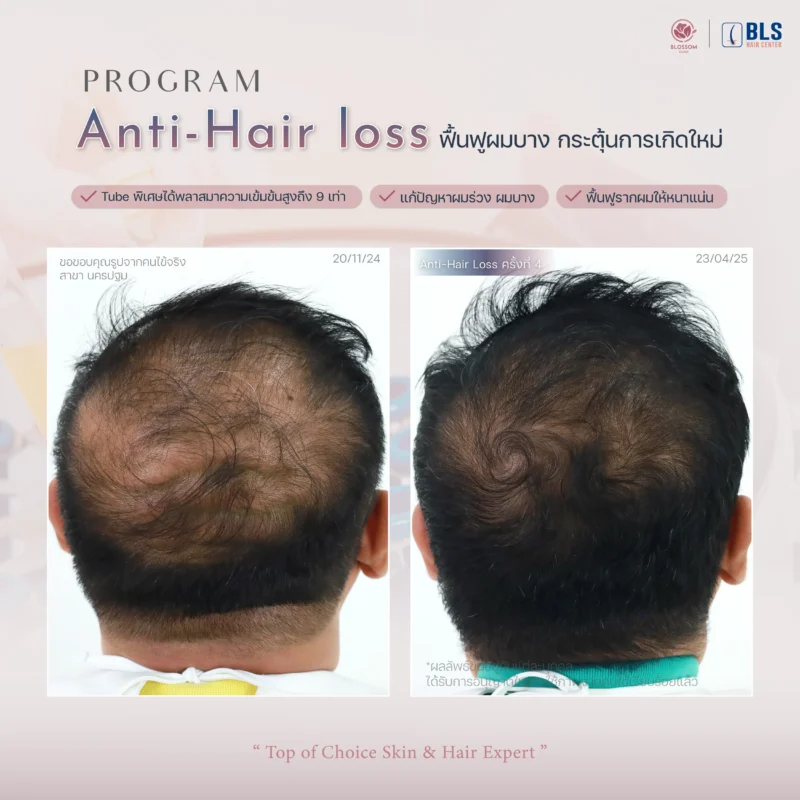 รีวิว PRP Hair ที่ บลอสซั้ม คลินิก