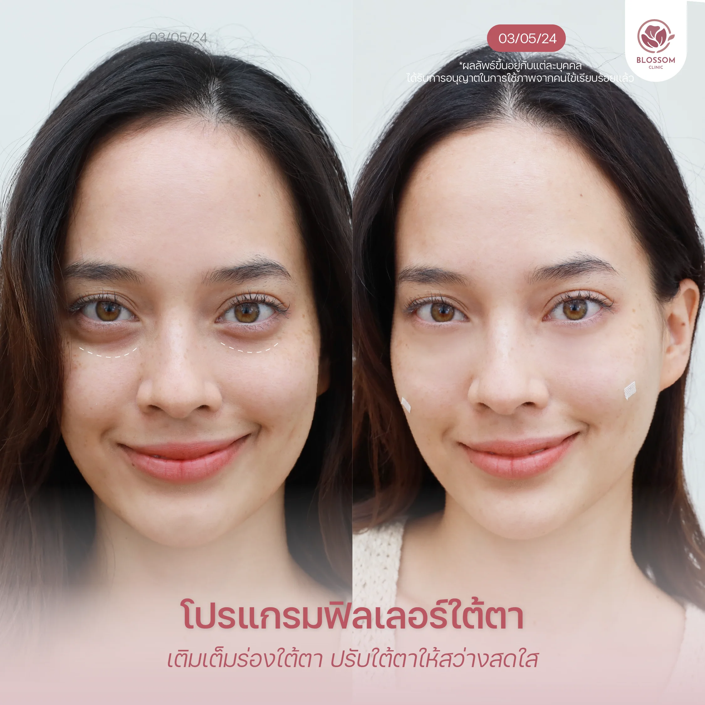 โปรแกรม Filler