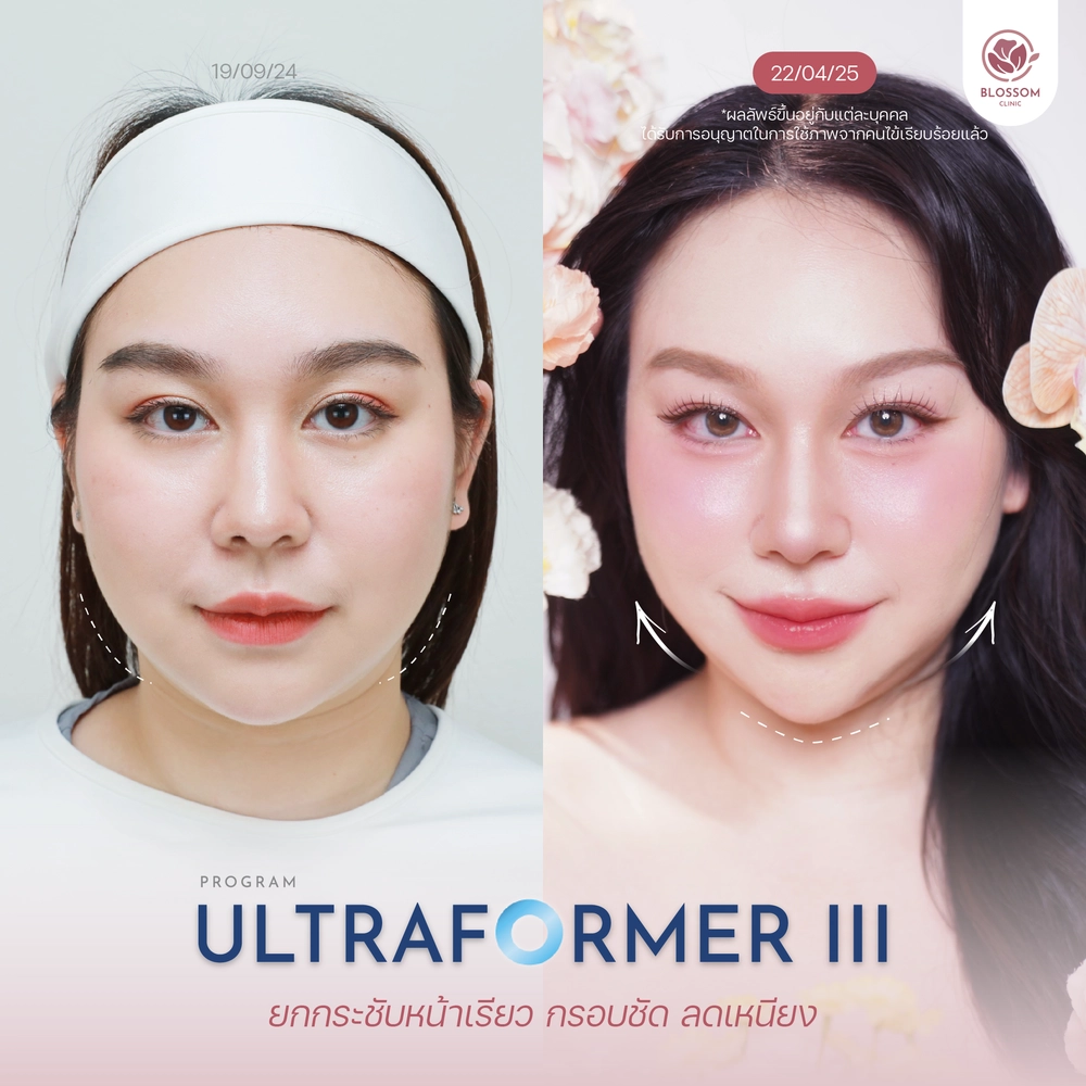 รีวิวผลลัพธ์หลังทำโปรแกรม Ultraformer III