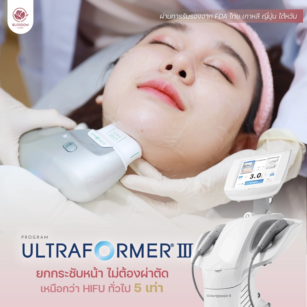 โปรแกรม Ultraformer III ยกกระชับหน้า ไม่ต้องผ่าตัด