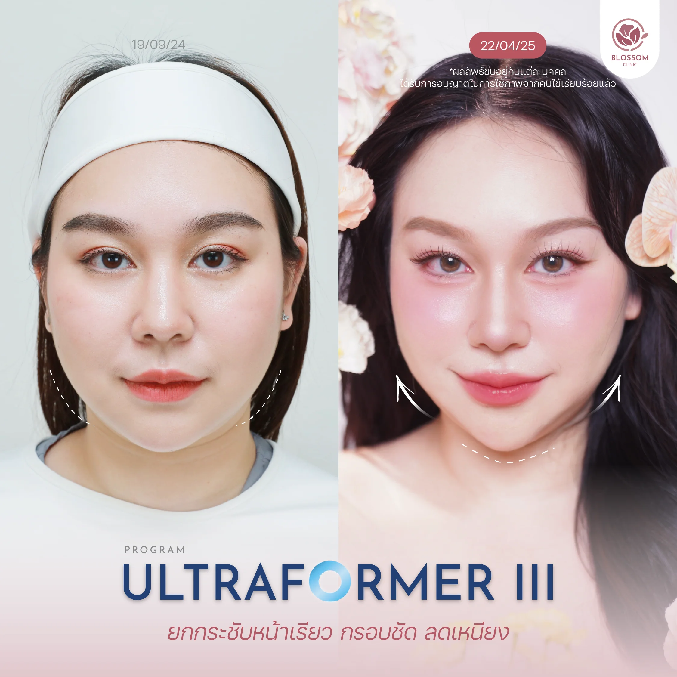 โปรแกรม Ultraformer III