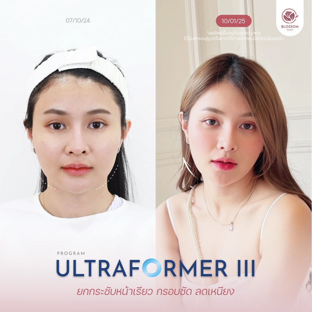 โปรแกรม Ultraformer III ทำบริเวณไหนได้บ้าง?