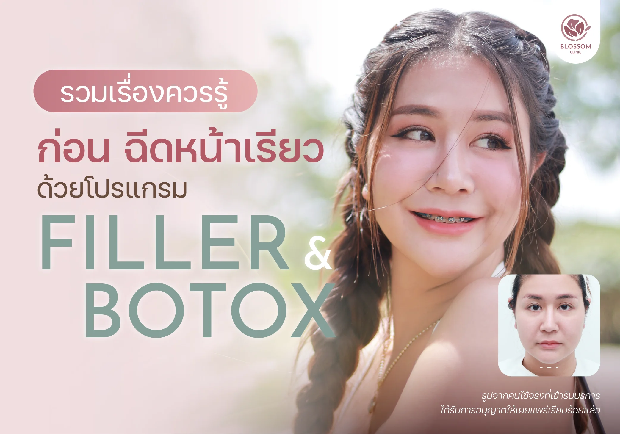 รวมเรื่องควรรู้ ก่อนฉีดหน้าเรียว ด้วยโปรแกรม Filler & โปรแกรม Botox