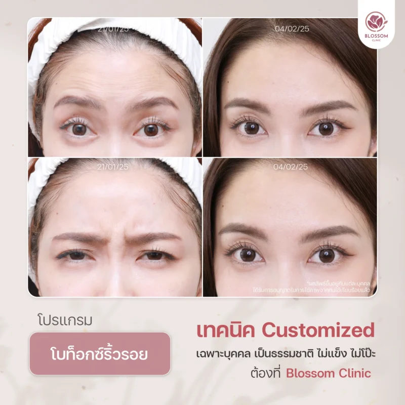 Reviews โปรแกรม Botox & โปรแกรม Filler ที่ Blossom Clinic