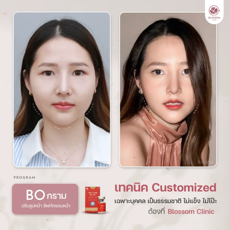 Reviews โปรแกรม Botox & โปรแกรม Filler ที่ Blossom Clinic