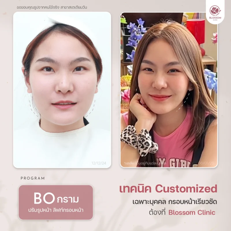Reviews โปรแกรม Botox & โปรแกรม Filler ที่ Blossom Clinic