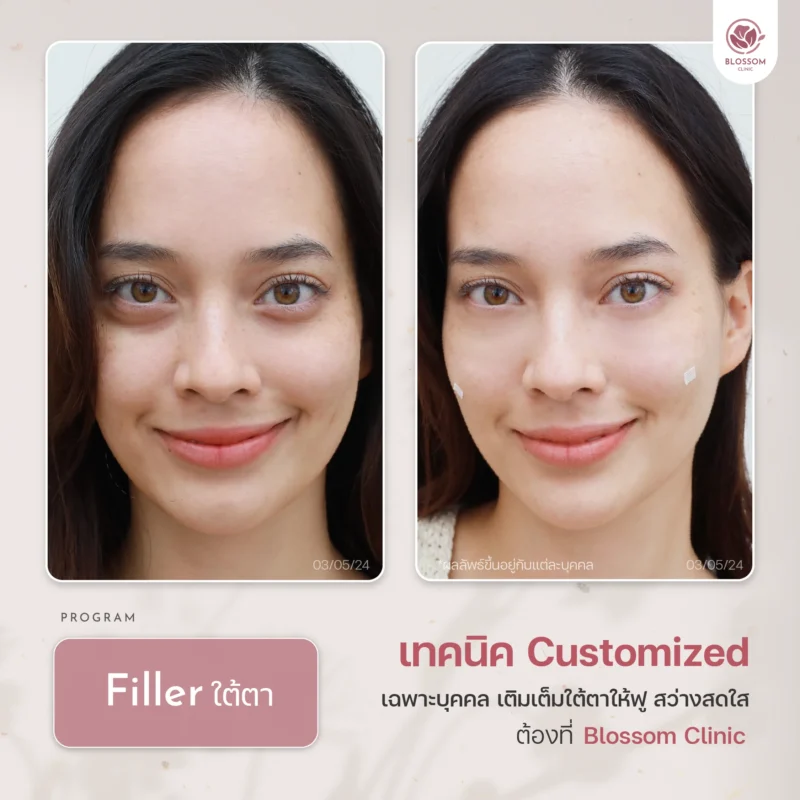 Reviews โปรแกรม Botox & โปรแกรม Filler ที่ Blossom Clinic