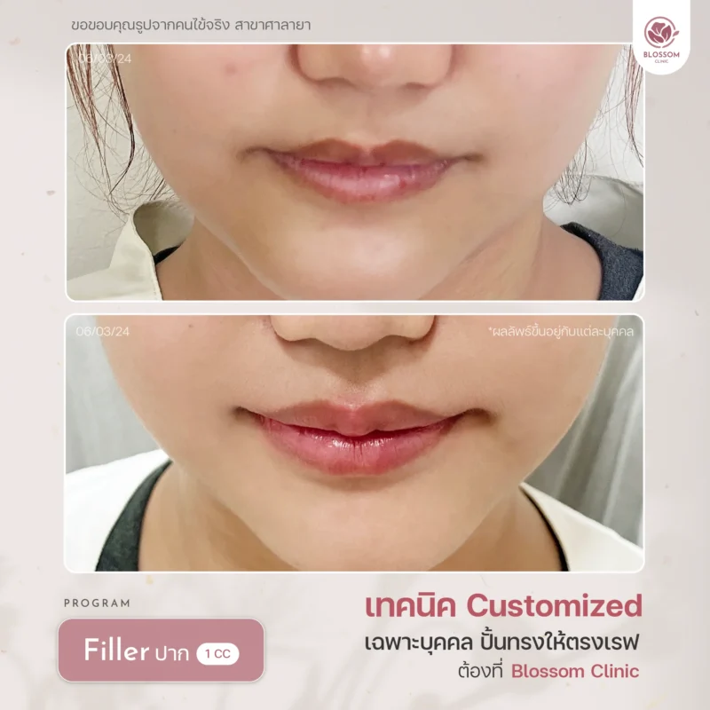 Reviews โปรแกรม Botox & โปรแกรม Filler ที่ Blossom Clinic