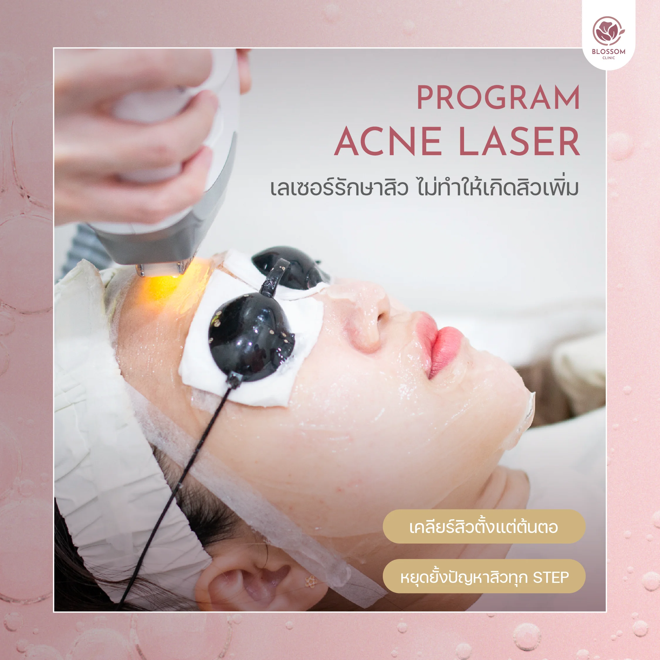 โปรแกรม Acne Laser