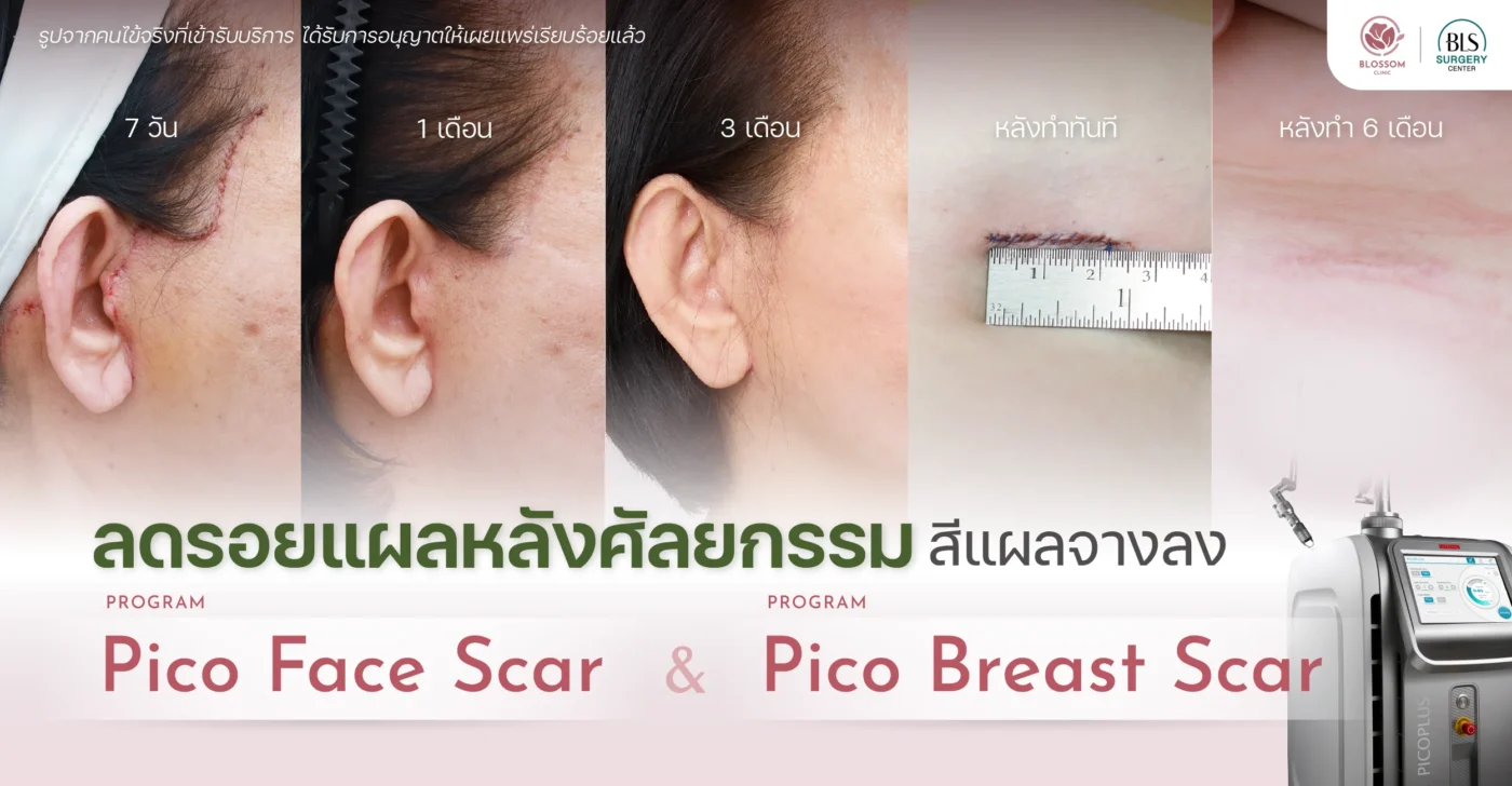มัดรวมมาเสิร์ฟ! 2 หัตถการลดสีรอยแผลหลังศัลยกรรม กับ โปรแกรม Pico Face Scar & Pico Breast Scar