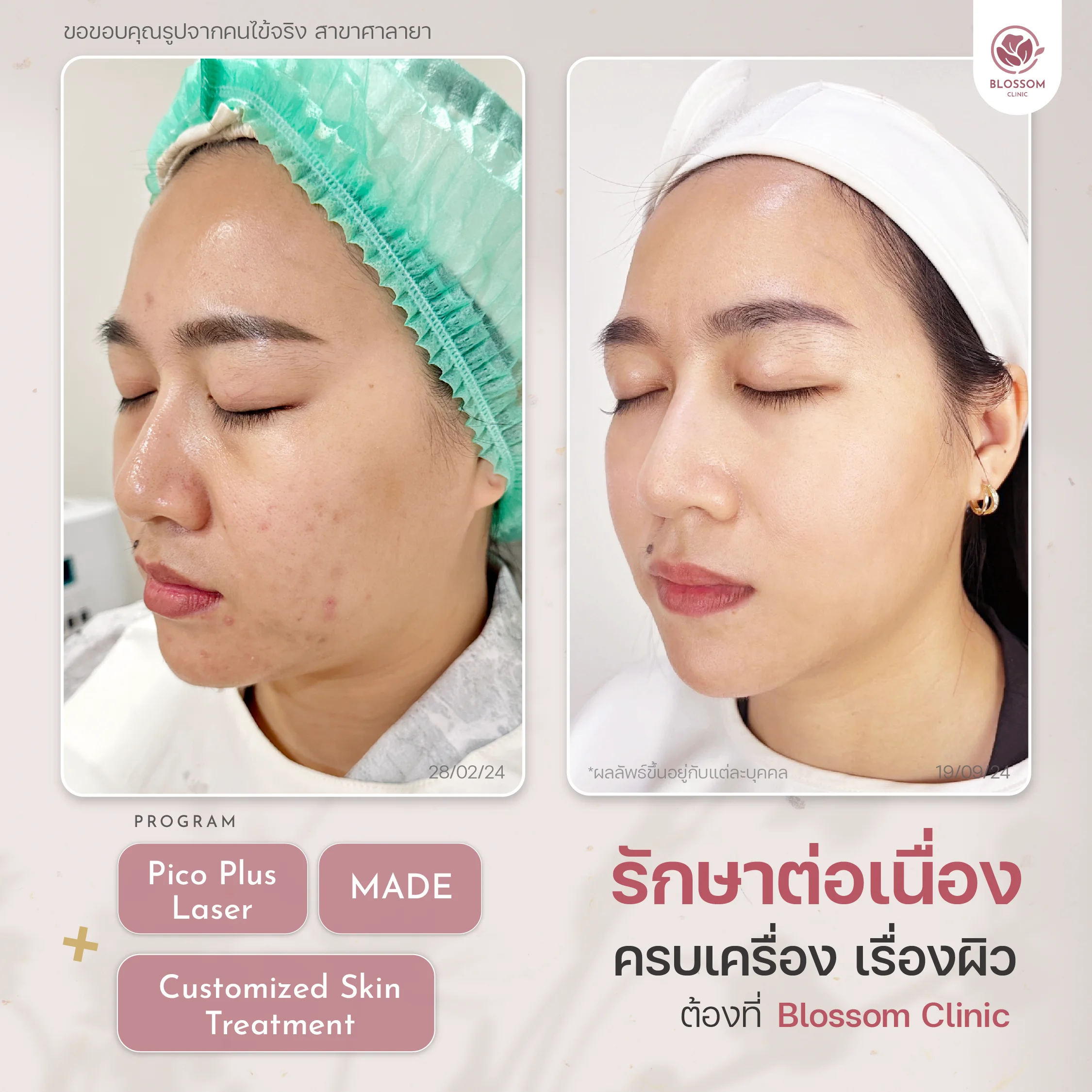 Review โปรแกรมรักษาสิว Blossom