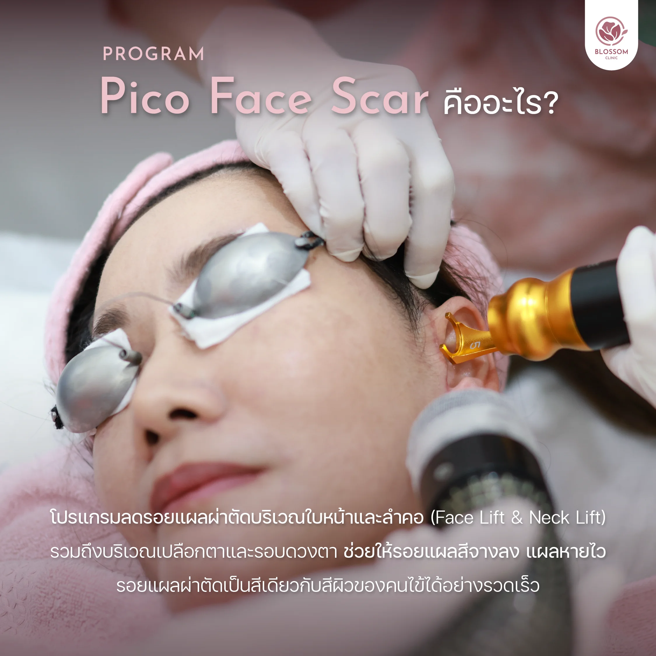โปรแกรม Pico Face Scar คืออะไร?
