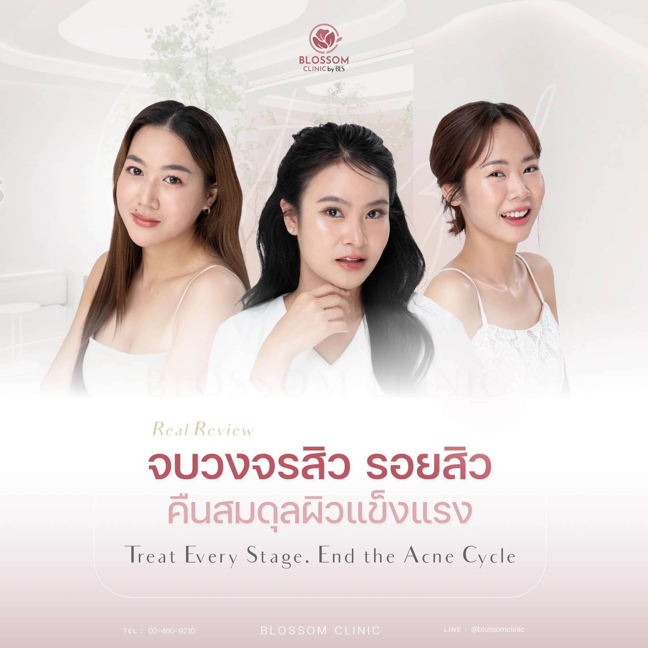 วิธีจัดการสิวเรื้อรังให้อยู่หมัด จบวงจรสิว รอยสิว