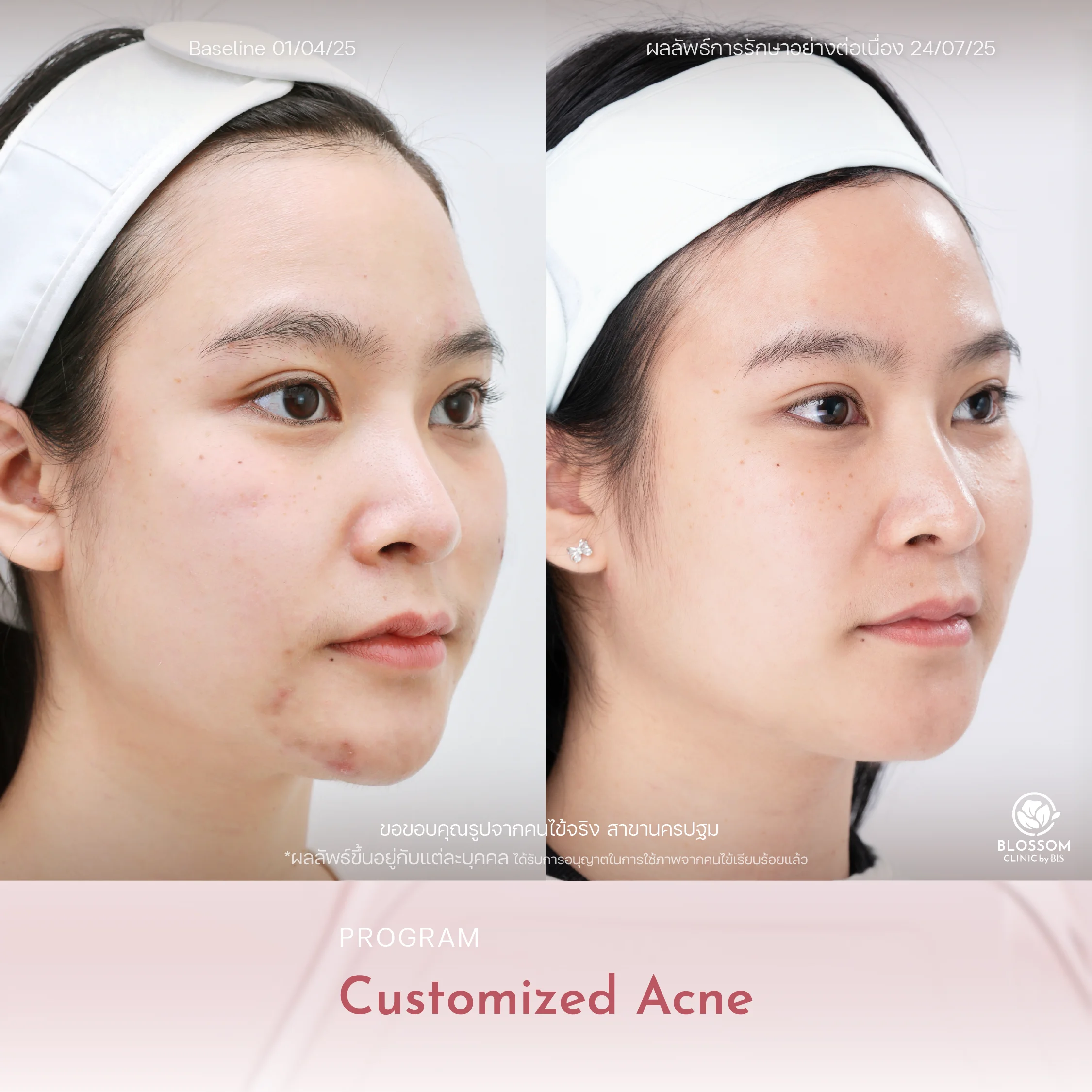 Review โปรแกรม Customized Acne Skin