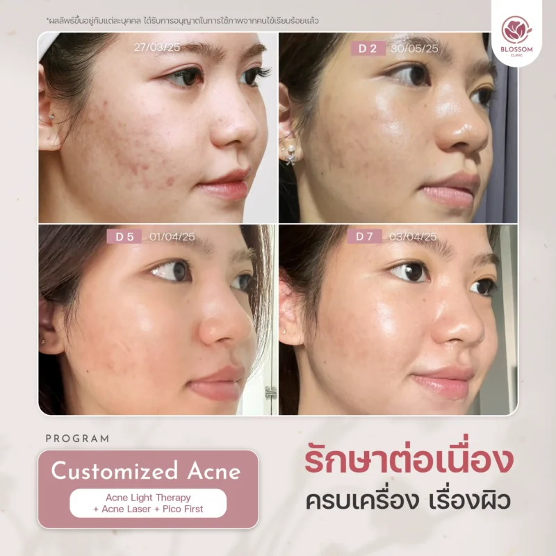 รีวิวจบปัญหาสิวเรื้อรัง เผยผิวใส ปังขั้นสุด ที่ Blossom Clinic