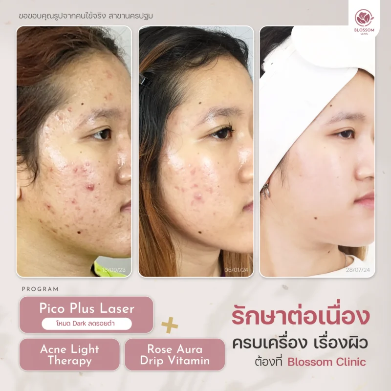 รีวิวจบปัญหาสิวเรื้อรัง เผยผิวใส ปังขั้นสุด ที่ Blossom Clinic