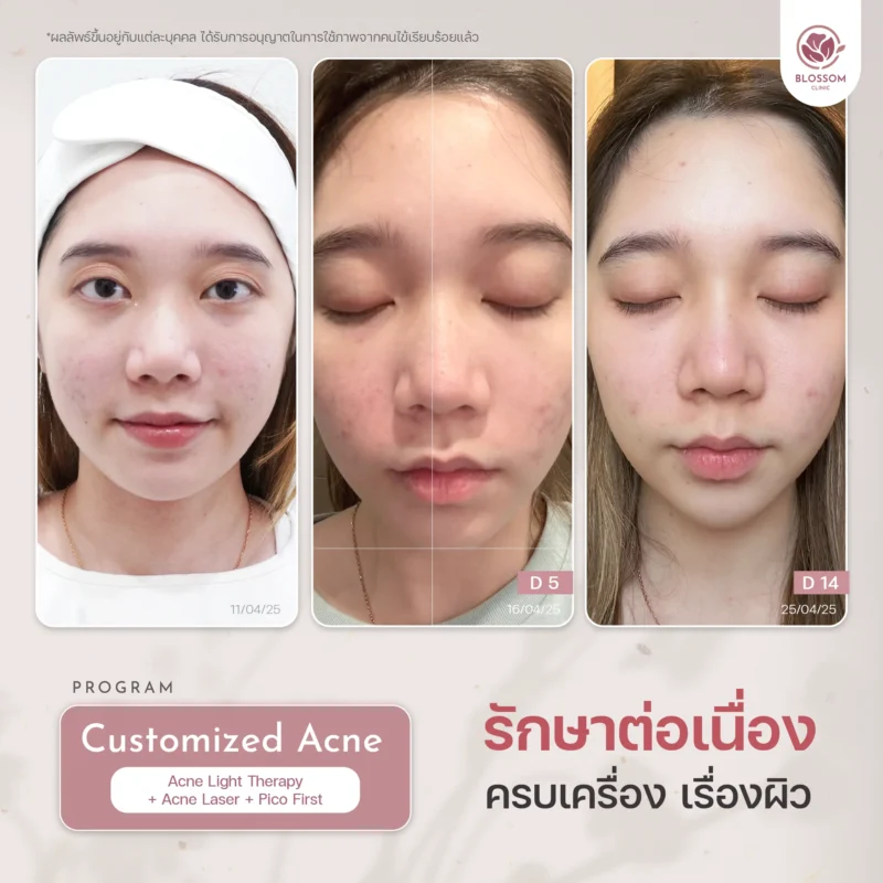 รีวิวจบปัญหาสิวเรื้อรัง เผยผิวใส ปังขั้นสุด ที่ Blossom Clinic