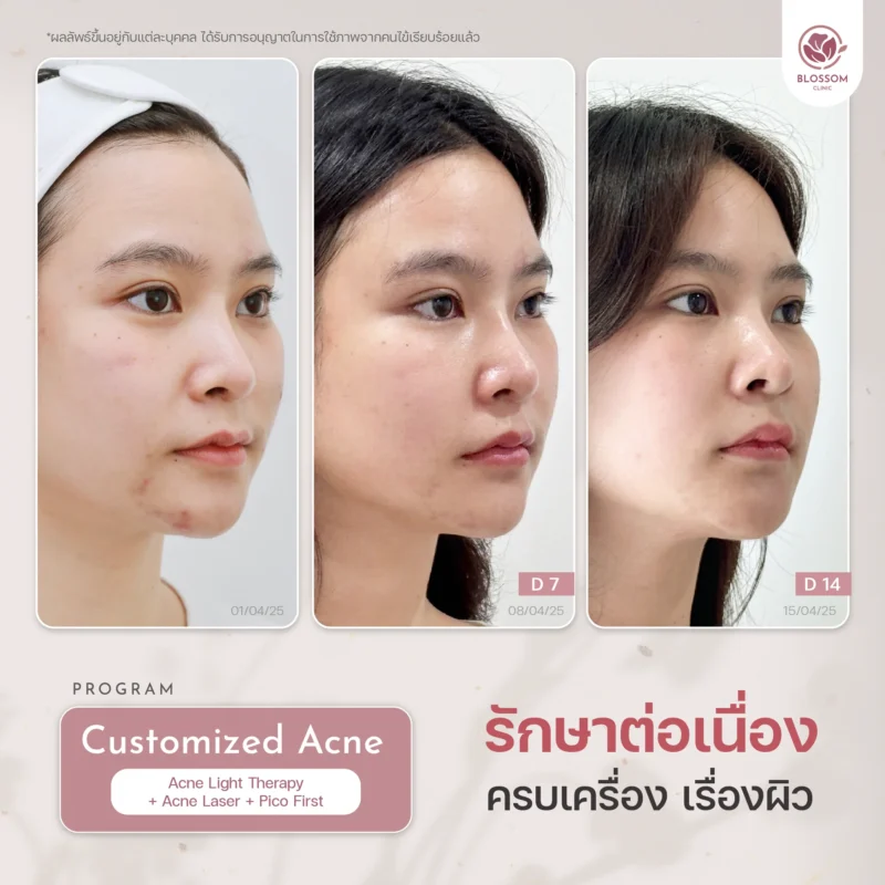 รีวิวจบปัญหาสิวเรื้อรัง เผยผิวใส ปังขั้นสุด ที่ Blossom Clinic