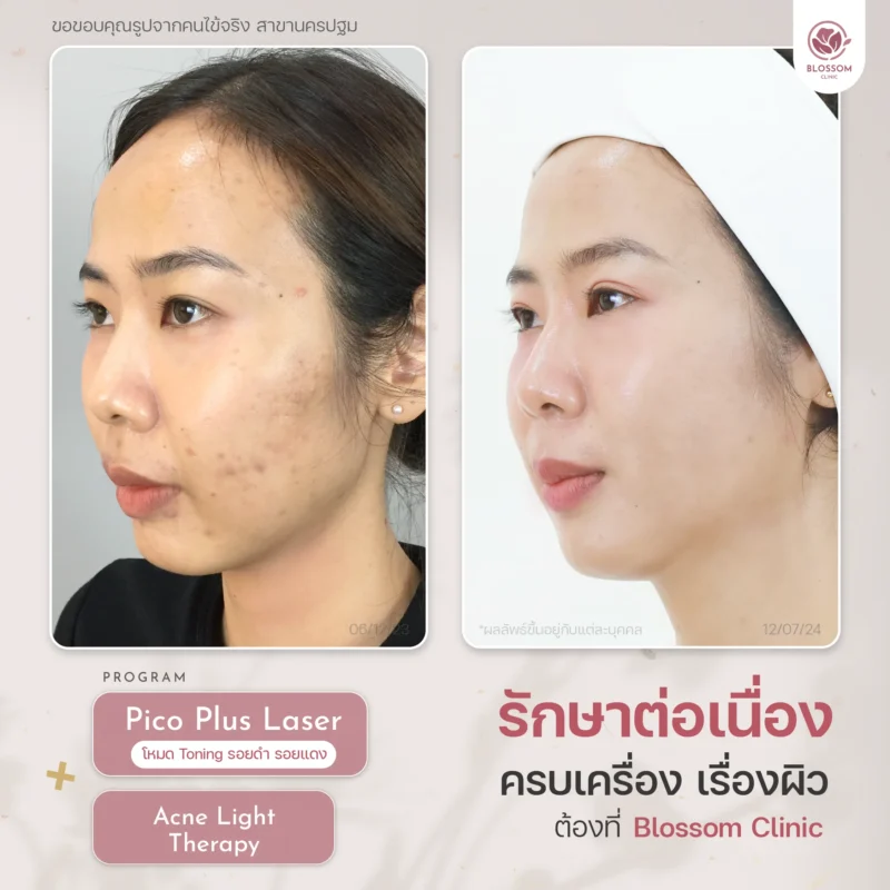 รีวิวจบปัญหาสิวเรื้อรัง เผยผิวใส ปังขั้นสุด ที่ Blossom Clinic