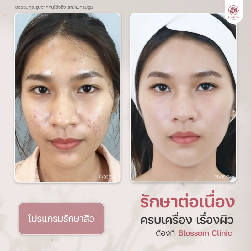 รีวิวจบปัญหาสิวเรื้อรัง เผยผิวใส ปังขั้นสุด ที่ Blossom Clinic
