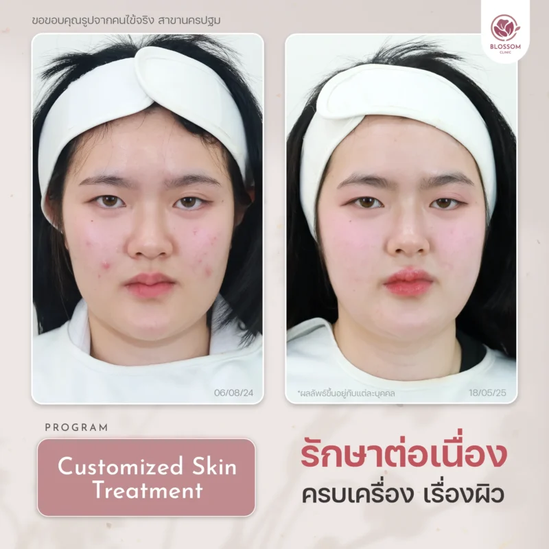รีวิวจบปัญหาสิวเรื้อรัง เผยผิวใส ปังขั้นสุด ที่ Blossom Clinic